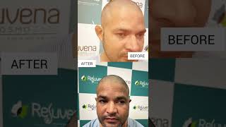 Ear Correction Otoplasty Before and After  Rejuvena Cosmo Care Jaipur  Dr Deepesh Goyal [upl. by Atalante569]