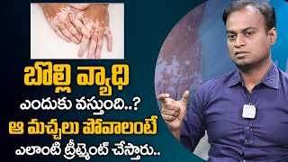 Vitiligo Symptoms Causes Treatment in Telugu  Dr Bharadwaz About Vitiligo  iDream Health [upl. by Eylrahc]