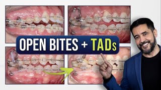 Anterior Open Bite  Adult Patients  TADs [upl. by Aileduab238]