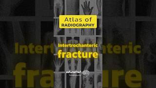 How to treat Intertrochanteric Fracture 🦵🔧 shorts fracture medical [upl. by Enelyad]