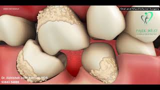 Importance of replacing a missing tooth  Dental Education Animation from Park West Dental CBE [upl. by Handy]