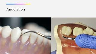 Optimize your Cavitron® Ultrasonic Technology The Three A’s of Ultrasonic Instrumentation [upl. by Laden561]