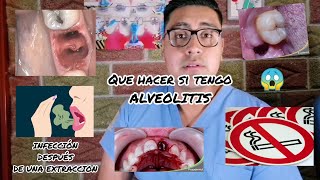 ¿INFECCIÓN DESPUES DE UNA EXTRACCION QUE HACER SI TENGO ALVEOLITIS [upl. by Anirda]