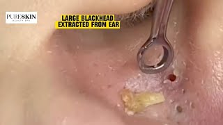 LARGE BLACKHEAD EXTRACTED FROM EAR  PURESKIN Beauty Spa Reacts Dr Dona Cravos asmr [upl. by Annaer]