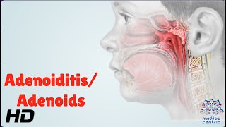 AdenoiditisAdenoids Everything You Need To Know [upl. by Cheatham]