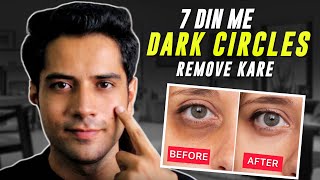 7 Days Dark Circles Removal Challenge  Permanent Treatment [upl. by Ellitnahc]