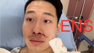 Septoplasty and Turbinate Reduction 2 Month Recovery and Review [upl. by Nottarts]