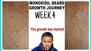 Minoxidil Beard Growth Journey Week 4 [upl. by Nazarius388]