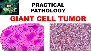 GIANT CELL TUMOR BONE Pathogenesis Clinical features amp Morphology [upl. by Areikahs]