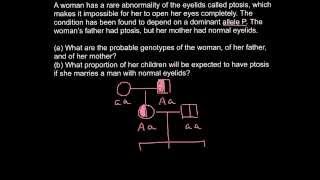 Ptosis  Dominant genetic disorder problem and solution [upl. by Nahsor]