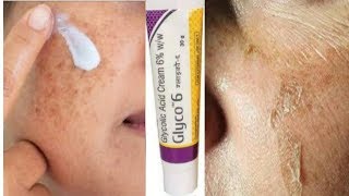 Glyco 6 Cream  glycolic acid  Remove pigmentation  Acne Scars  pimple marks [upl. by Ekaj]