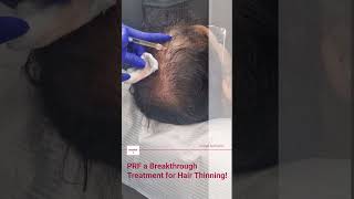 Hair PRF treatment procedure [upl. by Ahsinot]