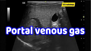 Ultrasound showing portal venous gas [upl. by Hochman490]