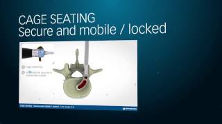 Transforaminal Lumbar Interbody Fusion cage [upl. by Attenyw708]