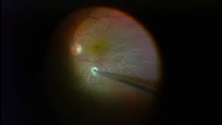 Vitrectomy for Retinal Detachment  Macula is Detached [upl. by Rusel]