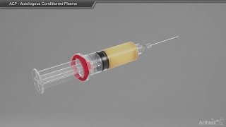 ACP  Autologous Conditioned Plasma [upl. by Nilhsa725]