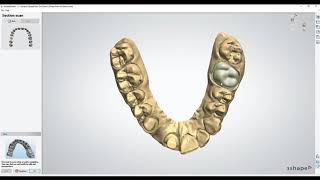 Form 3B  Removable Die Models in 3Shape Dental System [upl. by Airtemad]