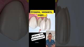 Crowns Veneers or Caps Whats the Difference dentallan dentist shorts [upl. by Niroc]