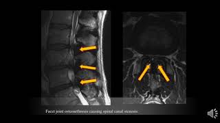 TMT MRI SPINE Pain Generators beyond disc [upl. by Higgs]