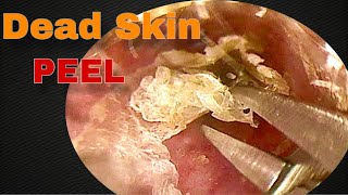 Dead Skin Peel and Ear Wax Removal  Doctor Anh [upl. by Darcy]