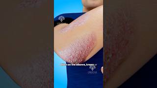 How Does Psoriasis Happen shorts viralvideo skincare  Creativelearning3d [upl. by Valente]