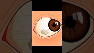 Bitot spot vitaminA nightblindness know ytshorts shorts biology neet eye disease [upl. by Sollars]