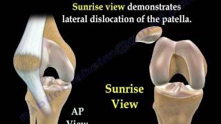 Patellar Dislocations  Everything You Need To Know  Dr Nabil Ebraheim [upl. by Peednus]