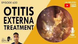 650  Treatment of Otitis Externa [upl. by Lewap]