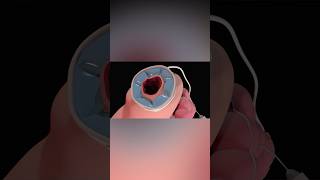 Gastric Band Adjustment medicalanimation health [upl. by Paske331]