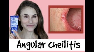 Angular cheilitis causes amp treatments a QampA with dermatologist Dr Dray [upl. by Clay]