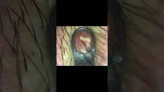 infected ingrown hair removal 😌 [upl. by Llerrem839]