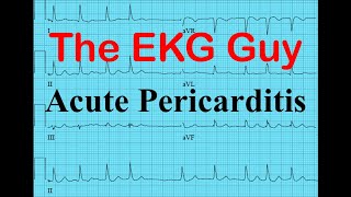 EKGECG in Acute Pericarditis  The EKG Guy  wwwekgmd [upl. by Pacheco]