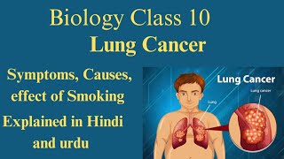 Lung Cancer Causes Symptoms Smoking effects Chapter 10 Biology Class 10 Explained in Hindi and urdu [upl. by Dirfliw451]