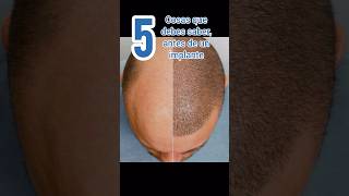 ✅ 5 Cosas que debes saber ANTES de un IMPLANTE CAPILAR 💆🏻‍♂️ pelo capilarte alopecia cabello [upl. by Meehyr687]