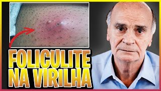 Foliculite na Virilha e Áreas íntimas [upl. by Ael]