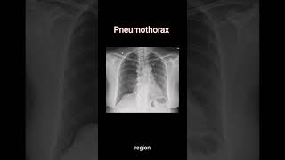 Diagnose Pneumothorax on chest Xray radiology cxr [upl. by Cowley]