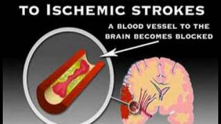 Symptoms of Stroke Stroke 3 [upl. by Llerrah]