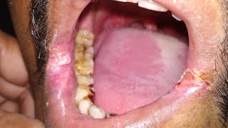 Leukoplakia signs and symptoms [upl. by Nnylyrehc]