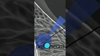 PreOp® Wire Localization Breast Biopsy Preparation Guide 🌿 preop shorts health 👩‍⚕️ [upl. by Retse]