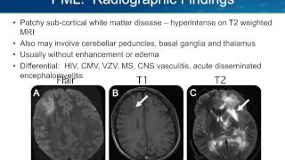 Progressive Multifocal Leukoencephalopathy PML [upl. by Ynned]