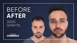 Transformation After Hair Transplant in Turkey at Dr Acars Clinic [upl. by Enecnarf895]