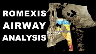 Romexis Airway Analysis [upl. by Cullan]