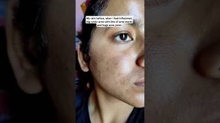 Using adapalene amp benzoyl peroxide gel in acne prone skin skin peel adapalenebenzoylperoxideacne [upl. by Frasier]