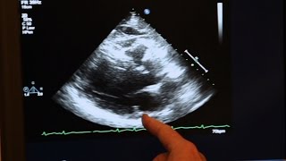 Echocardiogram Demonstration [upl. by Natassia]