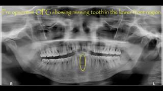 Lower front tooth  Flapless basal implant placement surgical video [upl. by Shanna751]