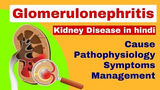 Glomerulonephritis  Nephritis in hindi  kidney disease  medical surgical nursing lecture [upl. by Tocci474]