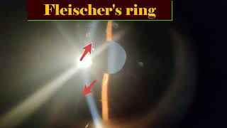 Kayser Fleischer Ring  Wilsons disease [upl. by Olwen]