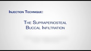 Module Supraperiosteal Buccal Infiltration [upl. by Bolling]