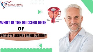 Prostate Artery Embolization Success vs common TURP prostate surgery [upl. by Wardlaw]