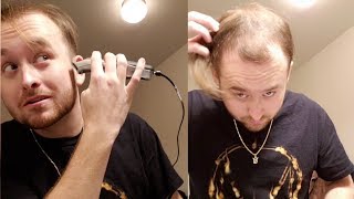 BALDING AT 20  Going Bald And Shaving My Head for good [upl. by Yeleek]